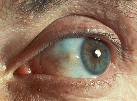 pterygia pinguecula  ocular surface squamous neoplasia gp eyes