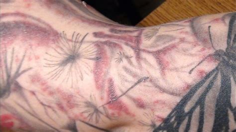 Study: Tattoo infections traced to tainted ink