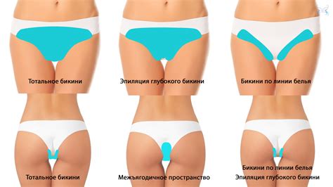 Лазерная эпиляция глубокого бикини, эпиляция тотального бикини в Санкт ...