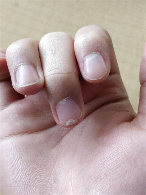 The damage to the nail bed from slamming my finger in a door has now ...