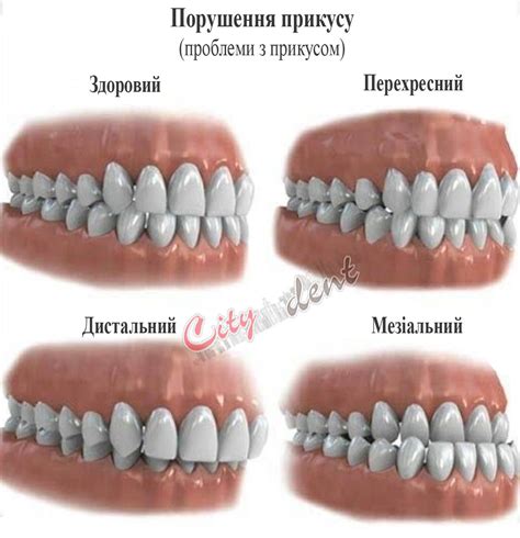 Хто такий лікар ортодонт? Як виправити неправильний прикус?