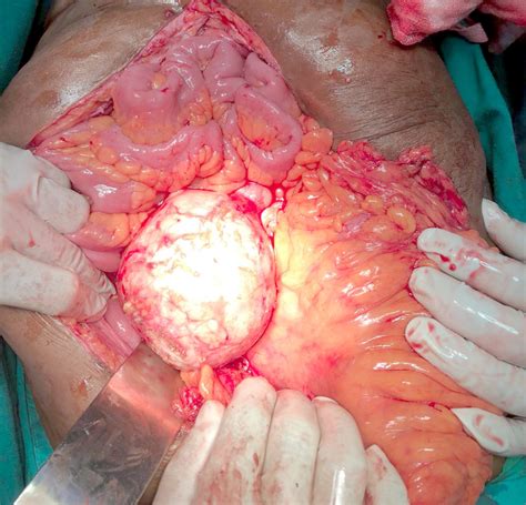 The large popping cysts medical mystery that baffled doctors 6