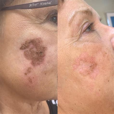 Fibroblast Plasma Pen Before & Afters — Skin Studio OKC