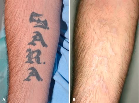 after tattoo removal care 3