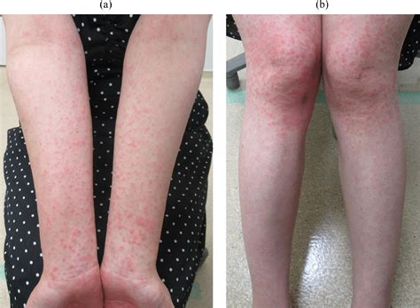 Skin rash following amoxicillin treatment - European Journal of