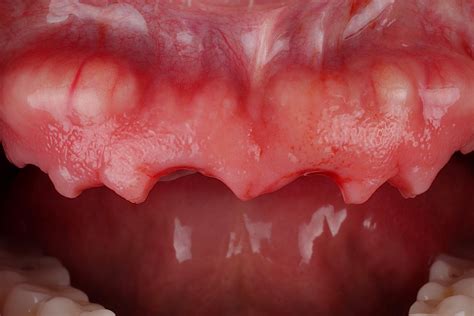 Partial Extraction Therapy: The Complete Course#N# – My EM Academy