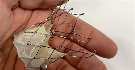 expanding tavr system   sealing cuff linked  high success