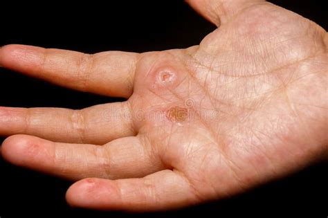 shingles shaking hands  isla lascelles blog