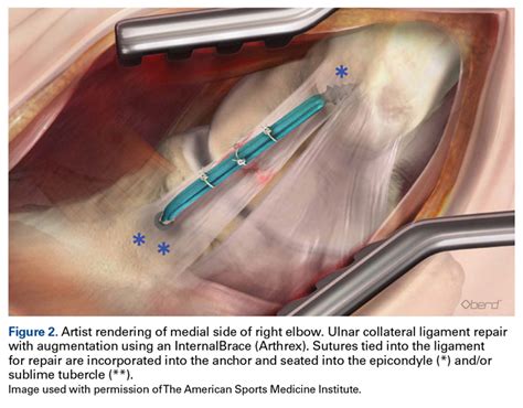 Ulnar Collateral Ligament Reconstruction: Current Philosophy in 2016 ...