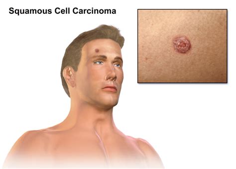 Squamous Cell Carcinoma (Squamous Cell Skin Cancer) - Rochester Hills ...