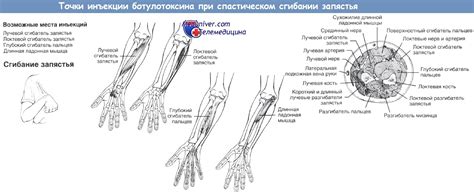 Схема ботулинотерапии спастического сгибания запястья