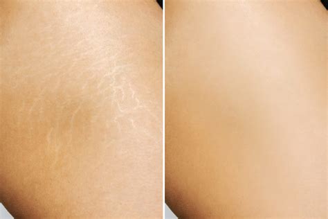 Britney Spears Stretch Marks Before After