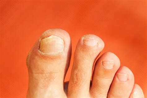 The essentials of fungal toenail infections | The Running Advisor