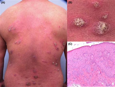 (A) Erythematous scaly plaques with desquamation on the back; (B ...