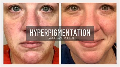 Hyperpigmentation - Causes and Remedies – Kalaia