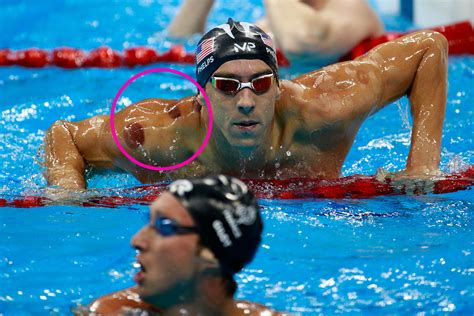 Spots on Michael Phelps - What is Cupping
