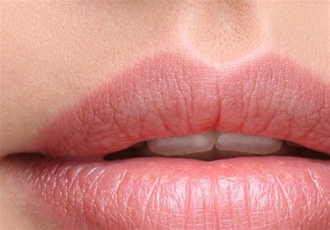 how long for lip fillers to settle