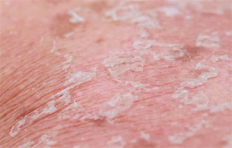 310+ Ichthyosis Stock Photos, Pictures & Royalty-Free Images - iStock