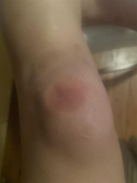 Is this pressure utricaria? : r/urticaria