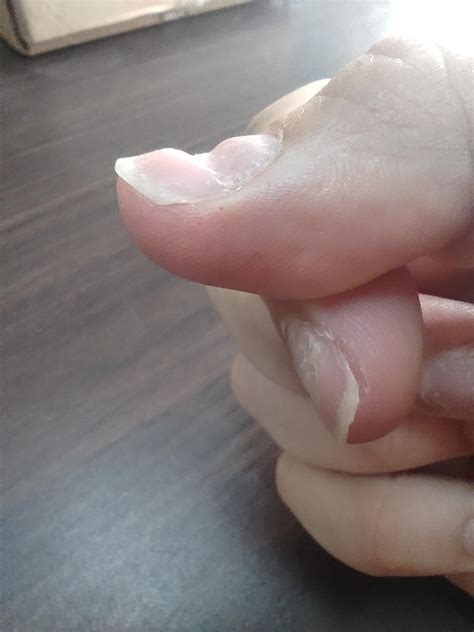 The small white lump on the roof of my mouth and cobblestone throat are