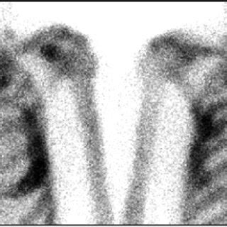 Technetium-99m bone scintigraphy shows diffusely increased uptake of ... 