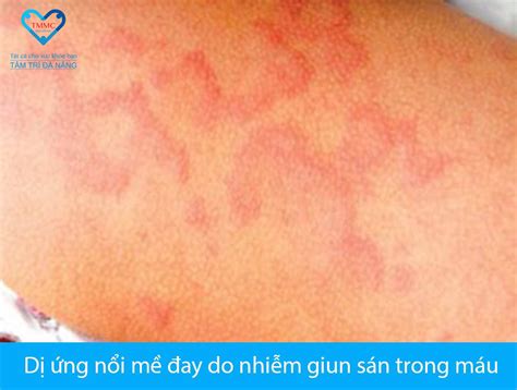xet nghiem tam soat cac benh giun san gay ngua