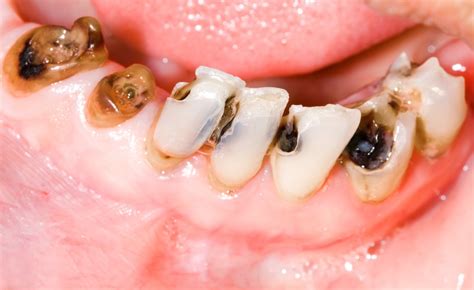 how to fix decaying tooth