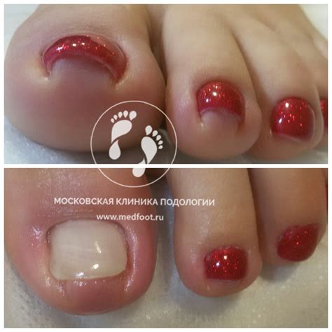 Проблема вросшего ногтя и деформации ногтевой пластины | Московская ...