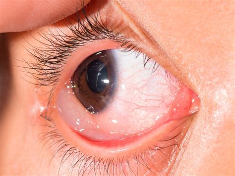 es la quemosis conjuntival sintomas causas  tratamiento