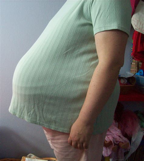 Diastasis Recti in Pregnancy Revisited