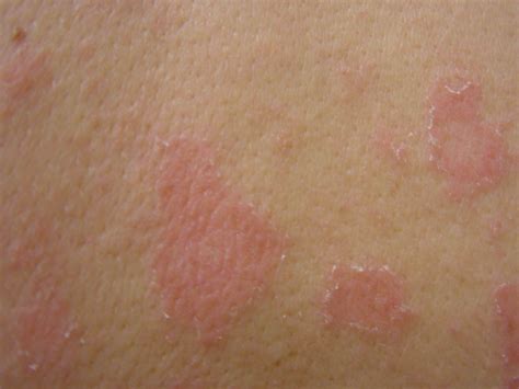 Pityriasis rosea - "herald patch"