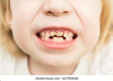 4,036 Kids With Bad Teeth Images, Stock Photos & Vectors | Shutterstock