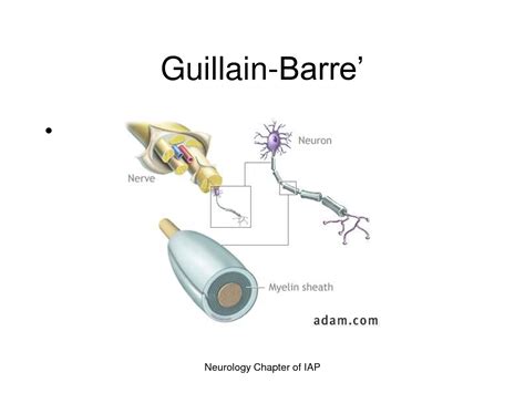 síndrome de Guillain-Barré