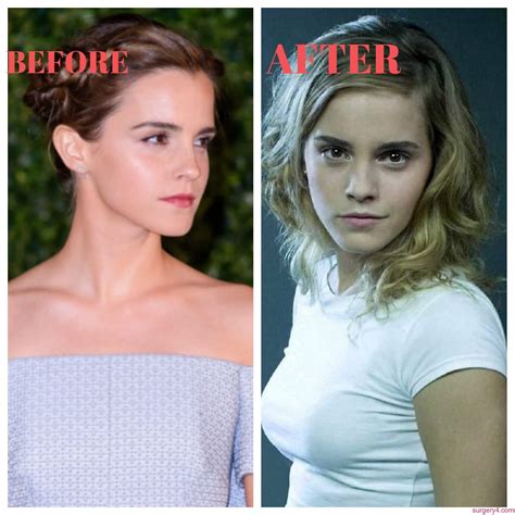Emma Watson Plastic Surgery Boob Job Photos [Before & After] - Surgery4