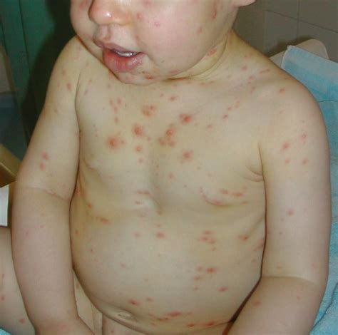 Varicella | Chickenpox (varicella zoster virus) lesions on a… | Flickr