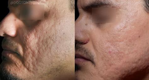 Salicylic Acid for Acne Scars: Is It An Effective Treatment?