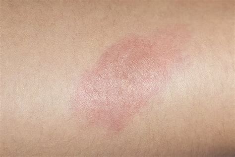minor burns skin regeneration eucerin