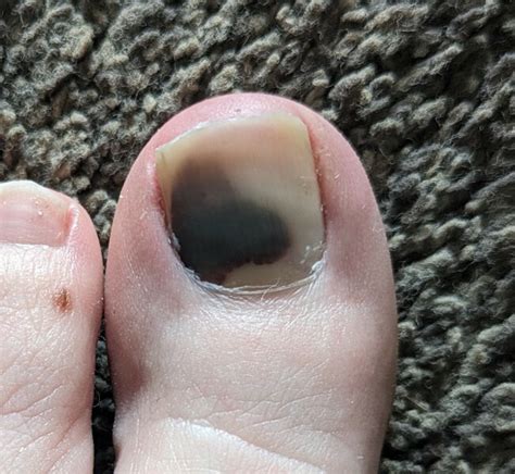 mole  toenail mumsnet