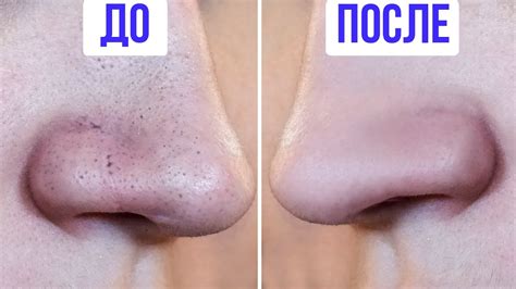 12 ПРОСТЫХ И БЫСТРЫХ СПОСОБОВ ИЗБАВИТЬСЯ ОТ ЧЕРНЫХ ТОЧЕК - YouTube