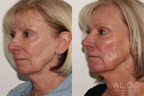 Dermal Fillers for Facial Volume | Hanover, MA | ALDA Aesthetics