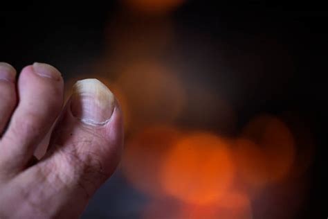 Curved Toenails Stock Photos, Pictures & Royalty-Free Images - iStock