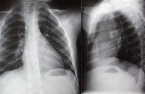 PNEUMOSTEM® - MEDIPOST