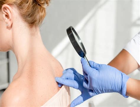 Брадавици: видове и лечение | DR—DENKOVA DERMATOLOGY