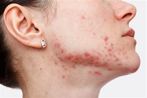PIH | Постинфламаторна Хиперпигментация | Eucerin