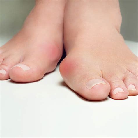 Do I need to have my bunions removed? | UofL Health