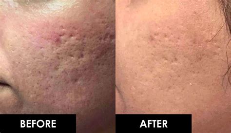 Microneedling Singapore - Best Acne Scar Removal Facial Treatment RF at ...