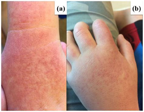 Erythropoietic Protoporphyria