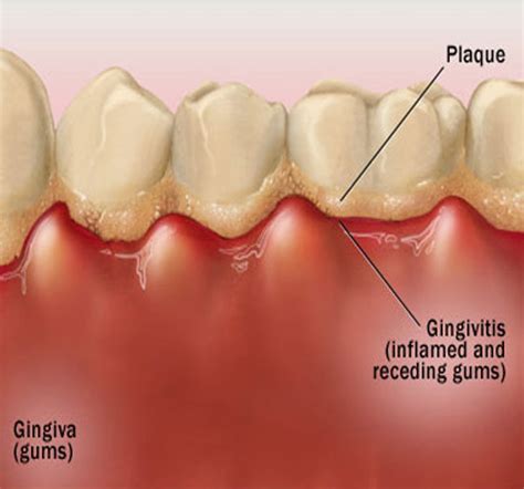 Dentist West Palm Beach FL: Treating Gingivitis