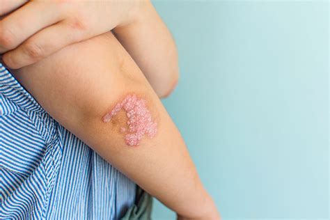 Psoriasis: Diagnosis, Triggers, and Treatment Approaches - Kulani Spa
