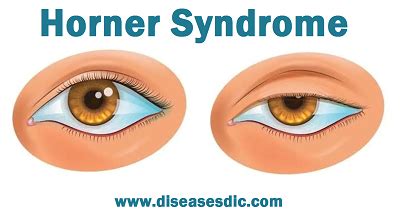 horner syndrome classification symptoms